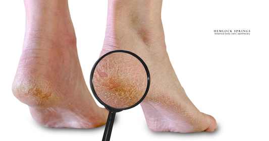 Why My Feet Look Like They Belong to a Hobbit Every Summer (And What I Do About It)