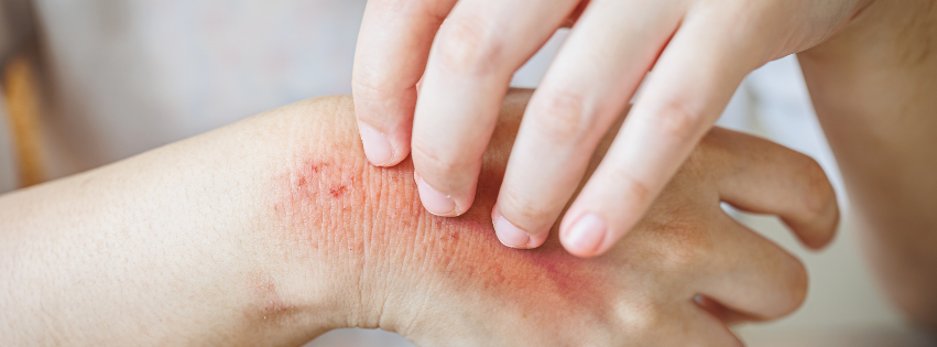 Is Handmade Soap Good for Eczema?