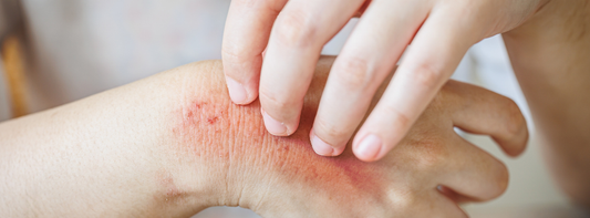 Is Handmade Soap Good for Eczema?